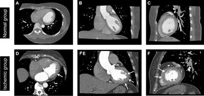 A novel hybrid machine learning model for auxiliary diagnosing myocardial ischemia